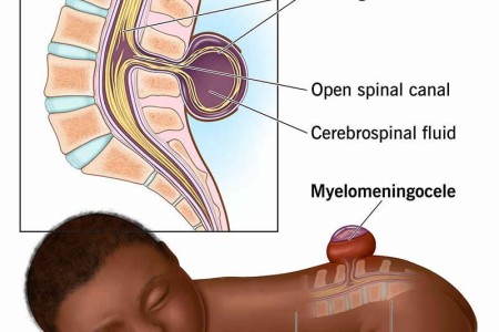 Myelomeningocele