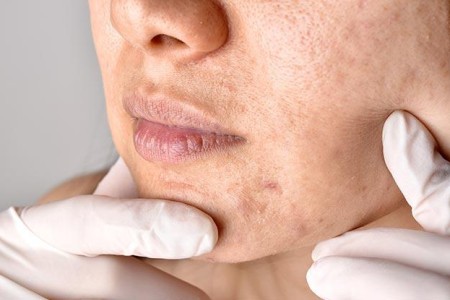 Clogged Pores