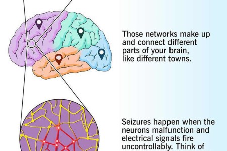 Seizure