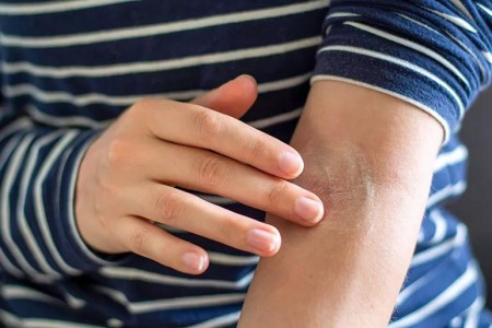 How To Choose the Best Eczema Cream