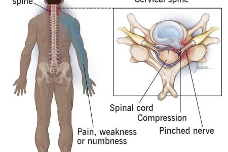Cervical Radiculopathy (Pinched Nerve)