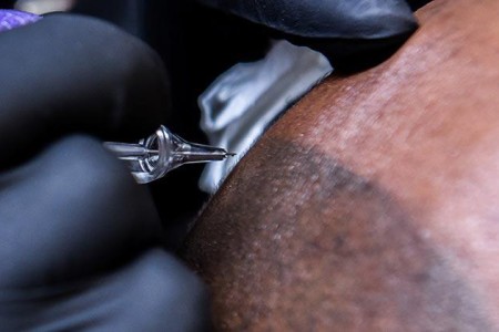 Scalp Micropigmentation