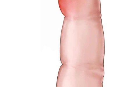 Felon Finger