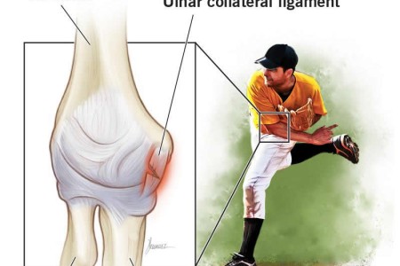 UCL (Tommy John) Injury