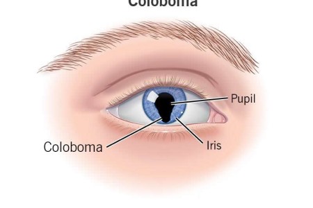 Coloboma