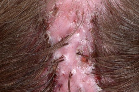 Folliculitis Decalvans