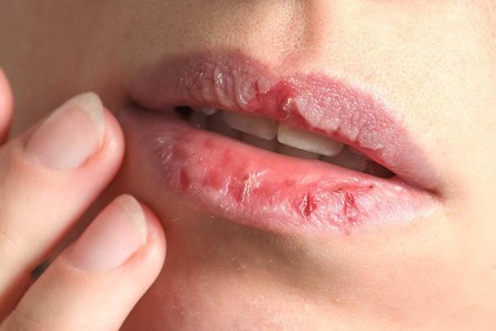 Dermatillomania (Skin Picking)