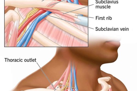 Arterial Thoracic Outlet Syndrome