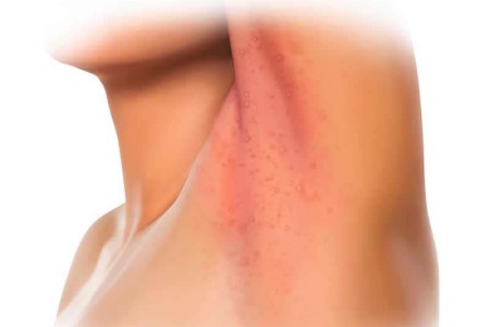 Armpit Yeast Infection