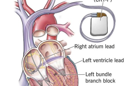 Cardiac Resynchronization Therapy