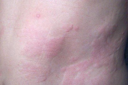 Chronic Hives (Chronic Idiopathic Urticaria)