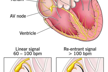 Atrioventricular Nodal Reentrant Tachycardia (AVNRT)