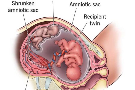Twin-to-Twin Transfusion Syndrome
