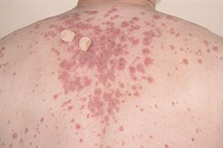 Pemphigus Vulgaris