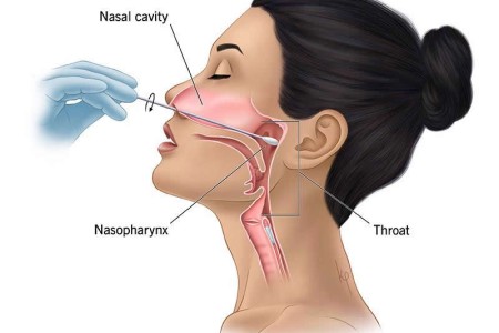 Nasopharyngeal Swab