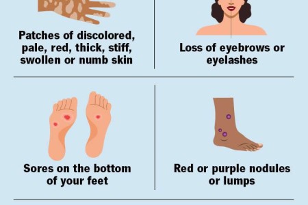 Leprosy (Hansen’s Disease)