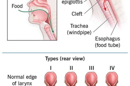 Laryngeal Cleft