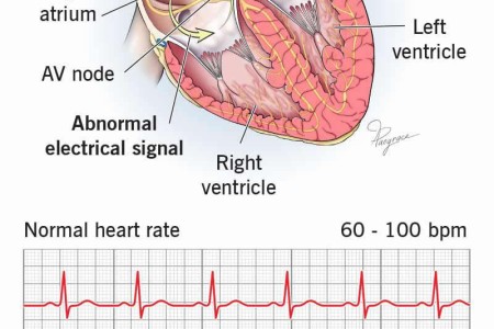 Atrial Flutter