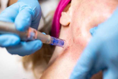 Microneedling