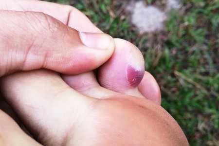 Blood Blister