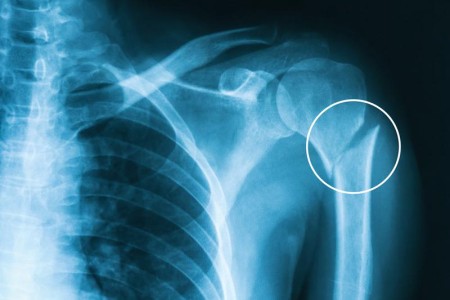 Humerus Fracture