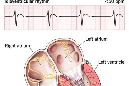 Idioventricular Rhythm