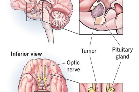 Craniopharyngioma