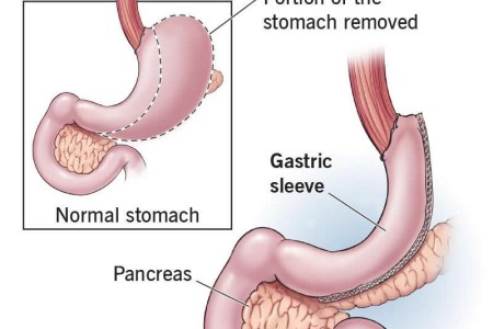 Gastric Sleeve Surgery