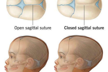 Scaphocephaly (Sagittal Craniosynostosis)