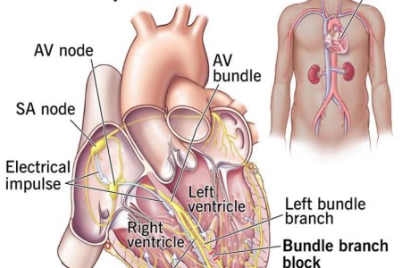 Bundle Branch Block