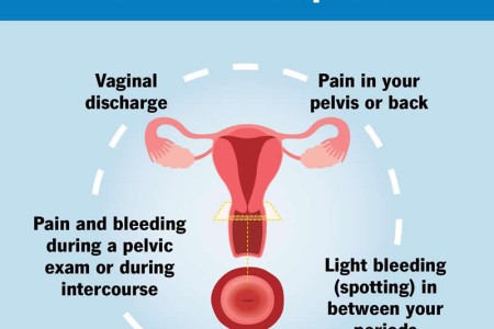 Cervical Ectropion