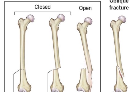 Transverse Fracture