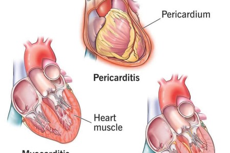 Heart Inflammation (Carditis)