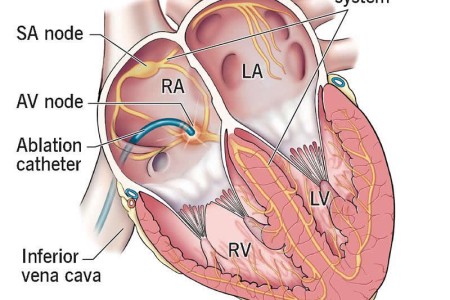 AV Node Ablation