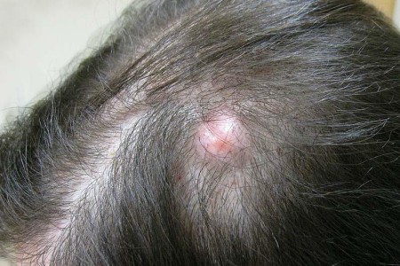 Pilar Cyst
