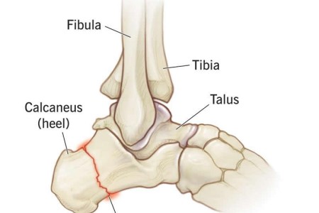 Calcaneus Fracture (Broken Heel)