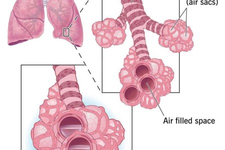 Cardiogenic Pulmonary Edema