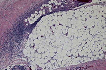 Necrotizing Fasciitis (Flesh-Eating Disease)