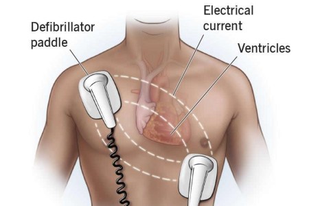 Defibrillation