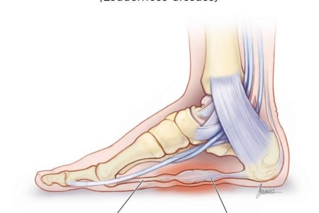Plantar Fibromatosis (Ledderhose Disease)