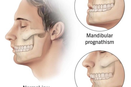 Prognathism