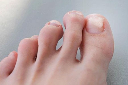 Onycholysis