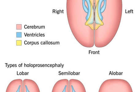 Holoprosencephaly (HPE)