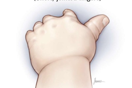 Symbrachydactyly (Short, Joined Fingers)