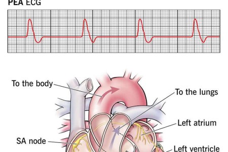 Pulseless Electrical Activity
