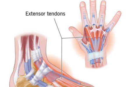Extensor Tendinitis