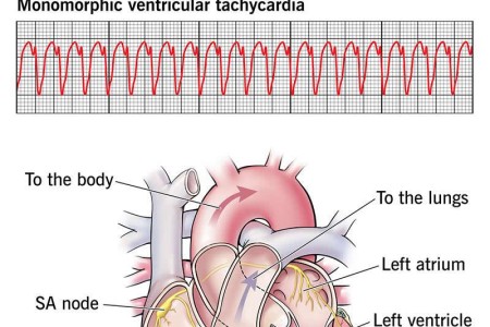 Monomorphic Ventricular Tachycardia