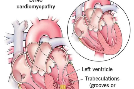 Left Ventricular Non-Compaction Cardiomyopathy