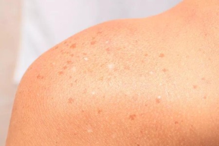 Why Do I Get White Spots on My Skin From the Sun?