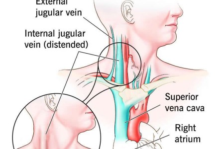 Jugular Vein Distention